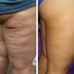 Before and after image of the effects of cellulite massage and fascia blasting on the back of the legs.